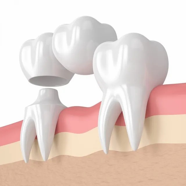 dental-bridge-768x768-640w