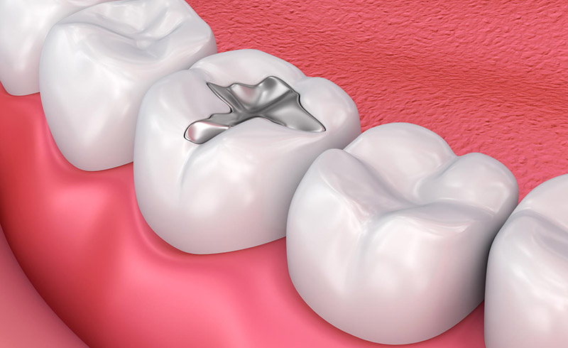 KFEGGM Metall dental fillings, Medically accurate 3D illustration