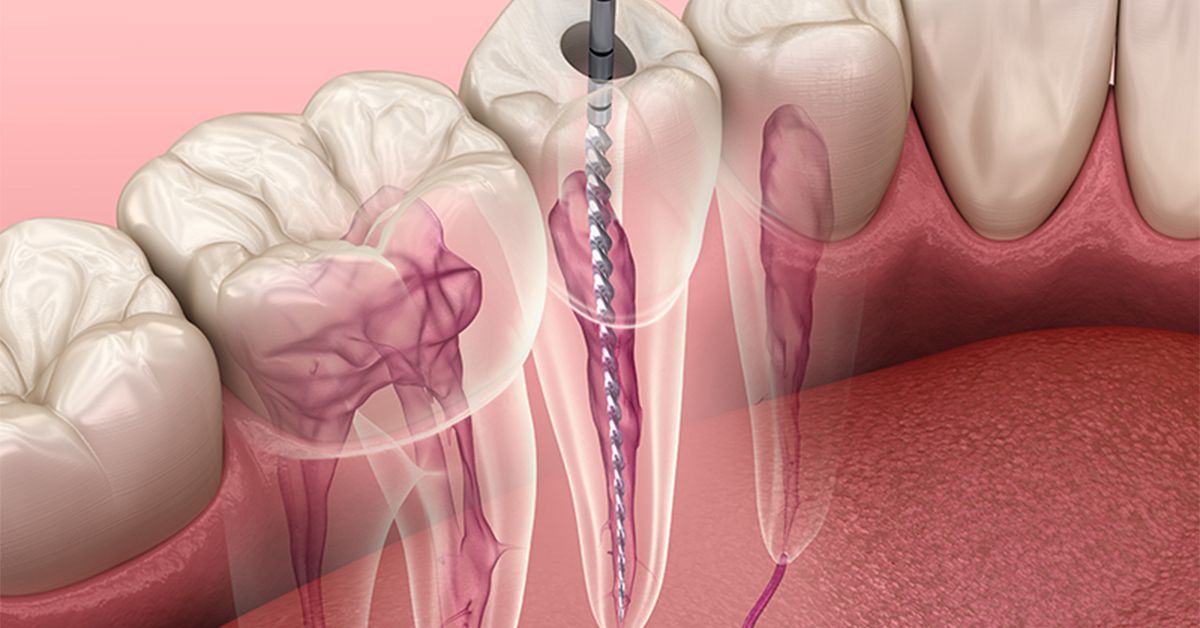 root-canal-treatment