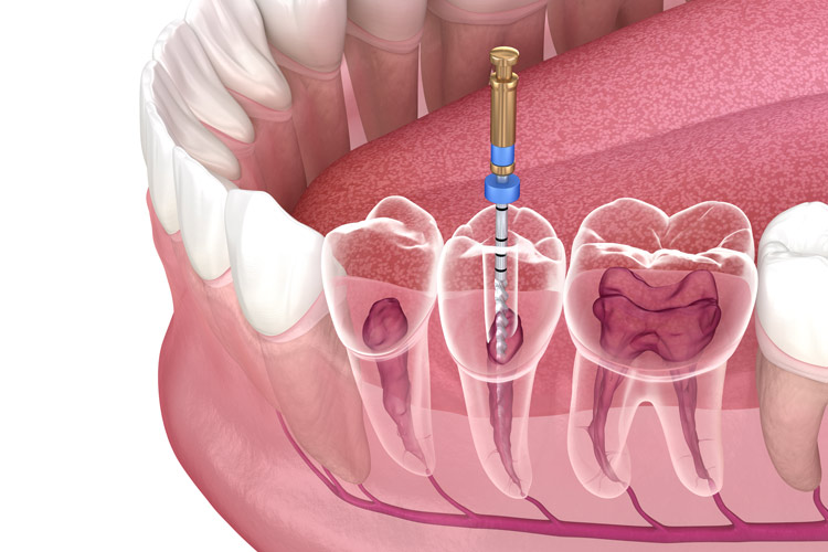 rootcanaltreatment