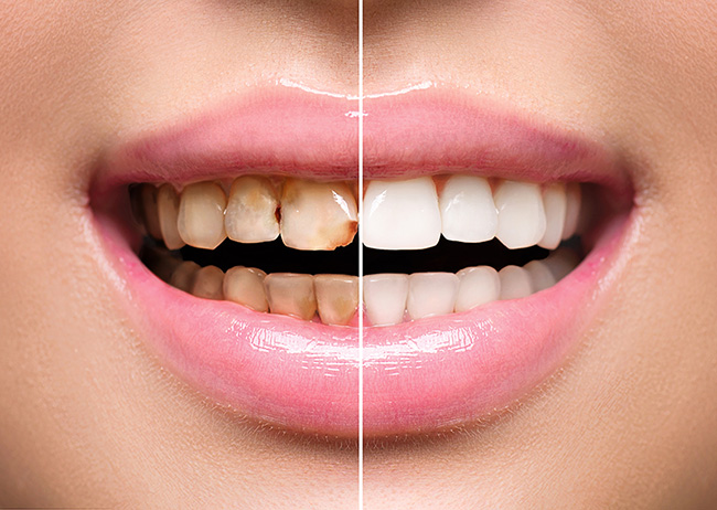 Woman Teeth before and after dental treatment. Teeth Whitening. Happy smiling woman. Dental health Concept. Oral Care, teeth restoration